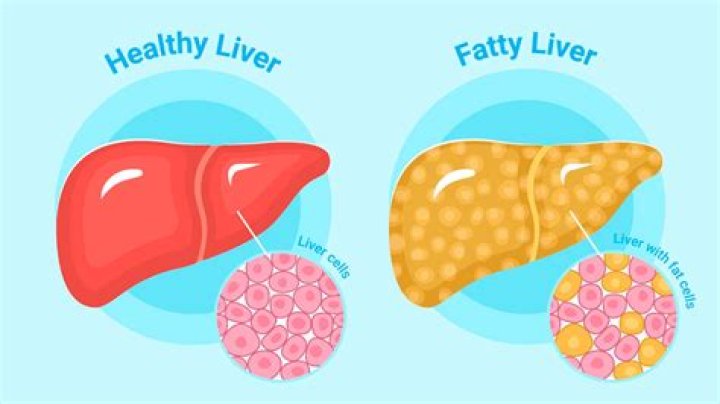 What is liver fatigue?