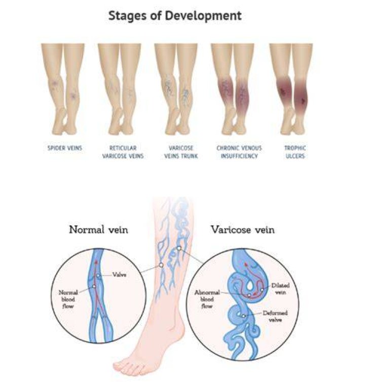 What should you not wear with varicose veins?