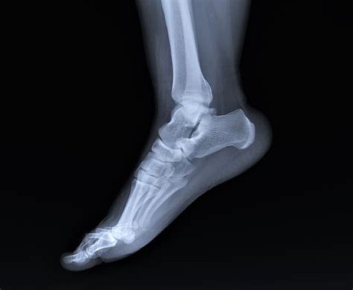 When should you get an xray for sprained ankle?