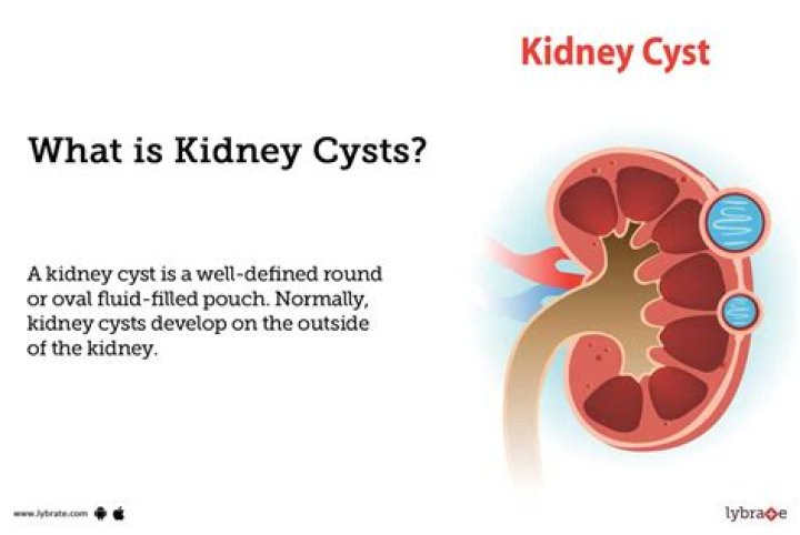 Why do people get cysts?