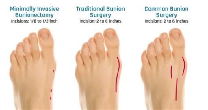 Why is bunion surgery so painful?