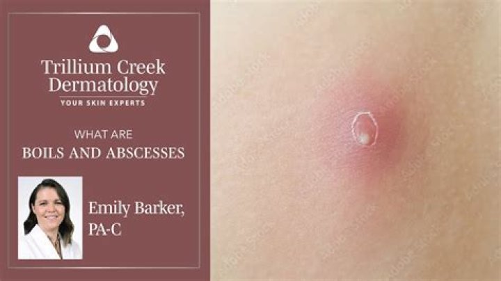 Why is my skin hard after a boil?